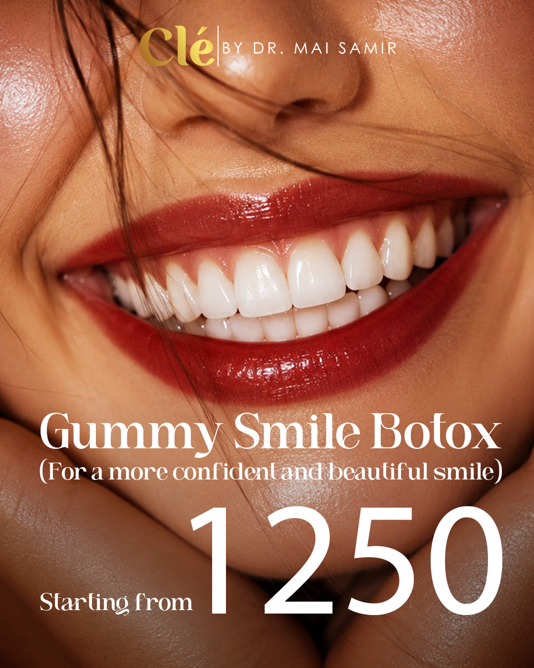 Botox for gummy smile (magic smile)