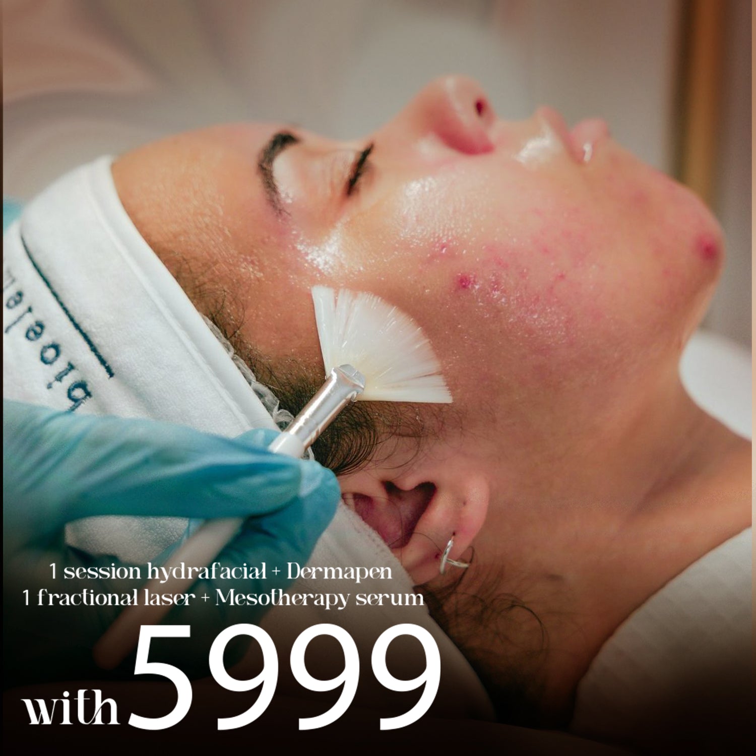 1 Session Hydrafacial + Dermapen<br>1 Fractional Laser + Mesotherapy Serum