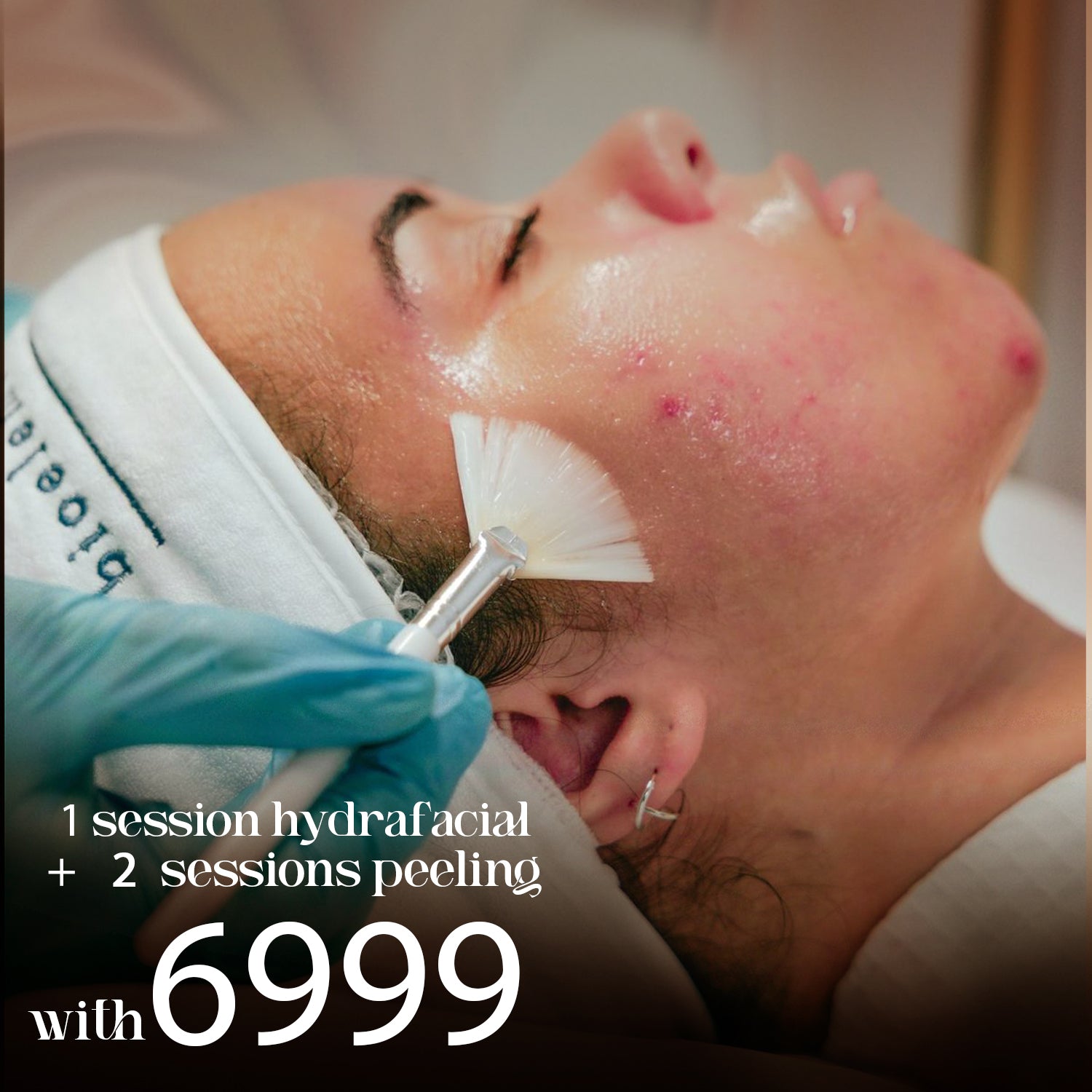 1 Session Hydrafacial + 2 Sessions Peeling